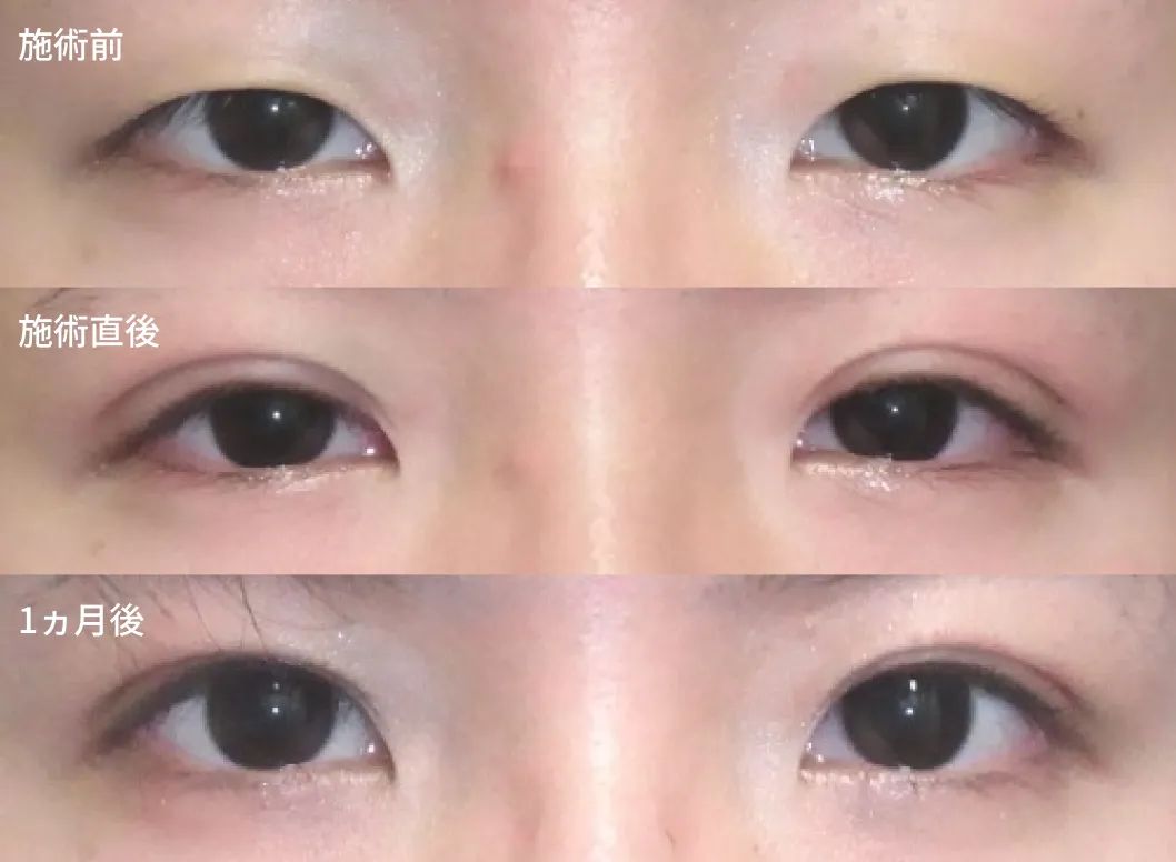 埋没法