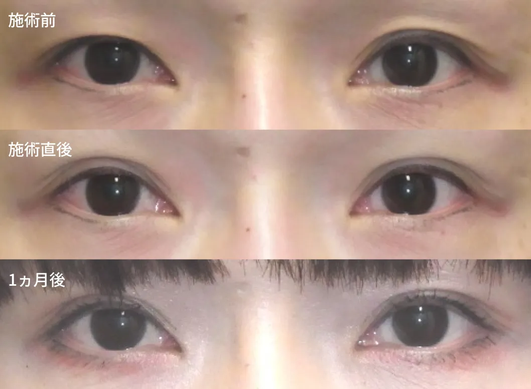 埋没法 #2