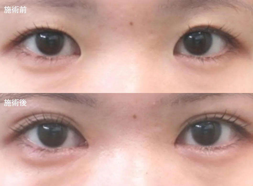 目頭切開＋埋没法