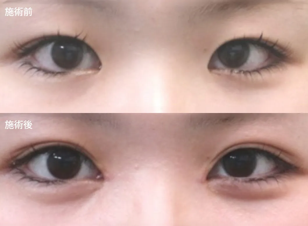 目頭切開＋埋没法