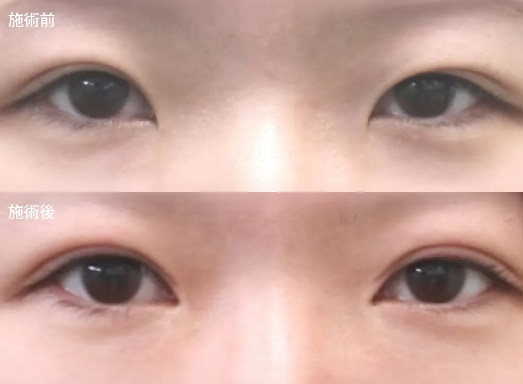 目頭切開＋埋没法