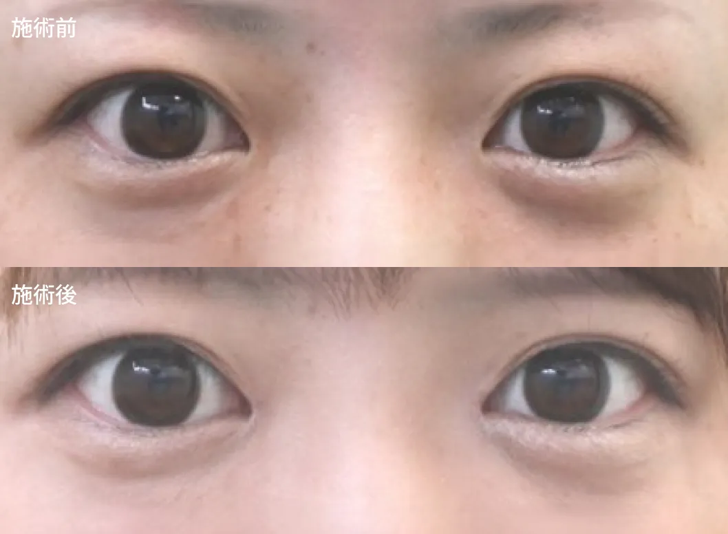 目頭切開